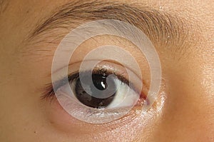 Outer view of nodule shaped style- chalazion on the lower eyelid of child. Papilledema photo