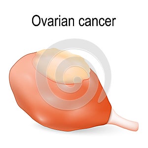 Ovarian cancer