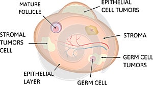 Ovarian cancer. cancer of epithelial layer,  germ cell, stromal tumors cell
