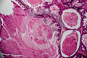 Ovarian cancer, light micrograph