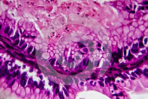 Ovarian cancer, light micrograph