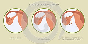 Ovarian cancer refers to any cancerous growth photo
