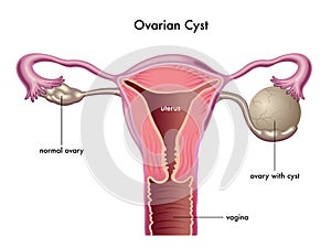 Ovarian cyst