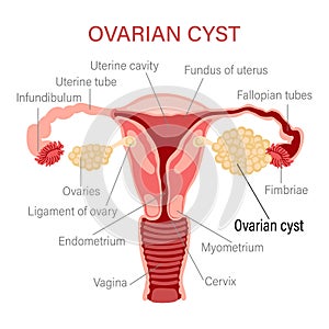 Ovarian cyst. Diseases of the female reproductive system. Gynecology. Medical concept. Infographic banner. photo