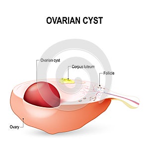 Ovarian cyst photo