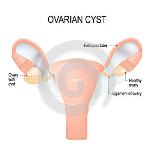 Ovarian cyst. A fluid-filled sac in the ovary. photo