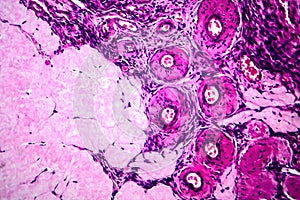 Ovarian cyst, light micrograph