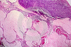 Ovarian cyst, light micrograph, photo under microscope