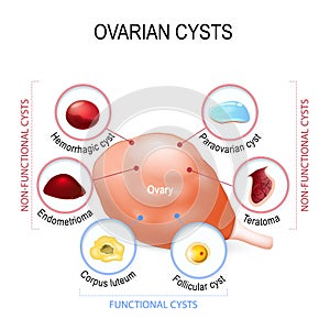 Ovarian cyst photo