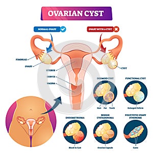 Ovarian cyst vector illustration. Labeled medical condition types scheme. photo