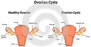 Ovarian Cysts photo