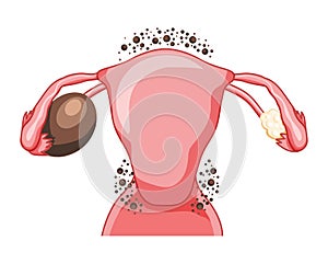 Ovarian endometriomas chocolate cysts Female reproductive system uterus problem. Human medical anatomy internal organs