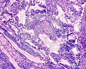 Ovarian epithelial cancer