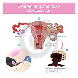 Ovarian lesions may trap menstruating blood, which from cysts kn