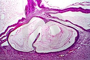 Ovarian mucinous cystadenoma, light micrograph