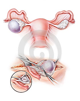 Ovaries - Cystectomy