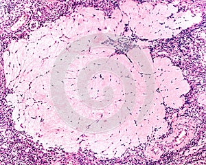 Ovary. Corpus albicans photo