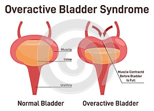 Overactive bladder syndrom. Normal bladder and bladder with urinary photo