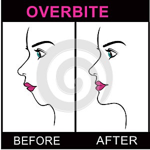 Overbite