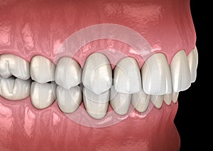 Overbite dental occlusion  Malocclusion of teeth . Medically accurate tooth 3D illustration