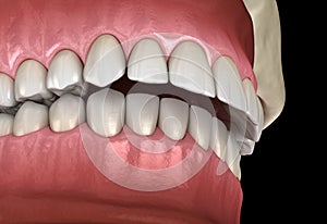 Overbite dental occlusion  Malocclusion of teeth . Medically accurate tooth illustration photo