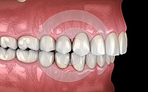 Overbite dental occlusion  Malocclusion of teeth . Medically accurate tooth illustration