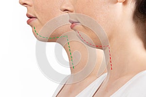 Overbite dental occlusion. Woman& x27;s face before and after correction of malocclusion of teeth isolated on white