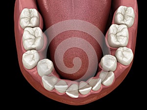 Overcrowded teeth, abnormal dental occlusion. Medically accurate tooth 3D illustration photo