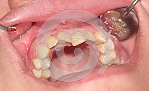 Overcrowding of the teeth