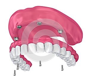 Overdenture to be seated on implants attachments. 3D illustration photo