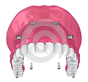 Overdenture to be seated on implants attachments.