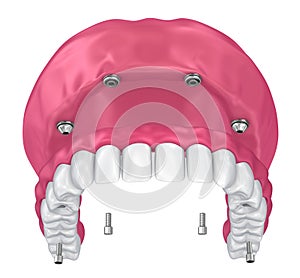 Overdenture to be seated on implants attachments