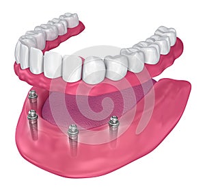 Overdenture to be seated on implants - ball attachments.