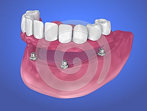 Overdenture to be seated on implants - ball attachments