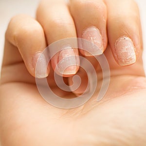 Overgrown cuticle fingernails and tainted nail plate. Gel nail polish fell off.