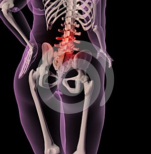 Overweight female skeleton with back pain