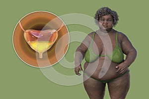 An overweight senior woman with a close-up view of her urinary bladder, 3D illustration