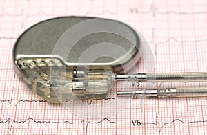 Pacemaker on electrocardiograph