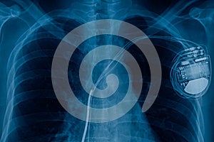 Pacemaker engine in heart