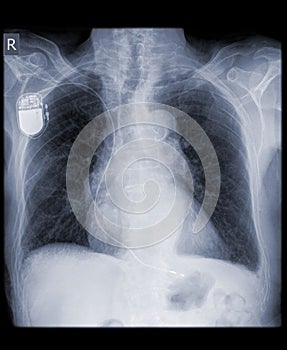 Pacemaker in old patient photo