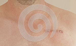 Pacemaker scar