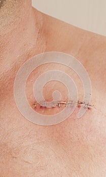 Pacemaker scar