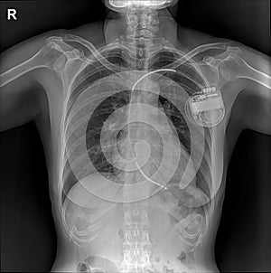 Pacemaker showing in chest x-ray