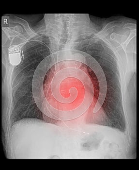 Pacemaker on x-ray