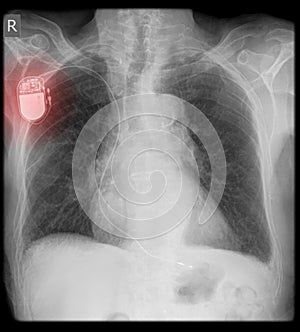 Pacemaker on x-ray with wire photo