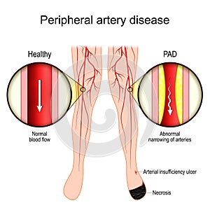 PAD. Peripheral Artery Disease. Vascular disease