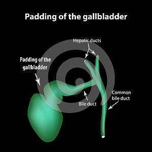 Padding of the gallbladder. Pathology of the gallbladder. Cholecystitis. The structure of the gallbladder. Infographics