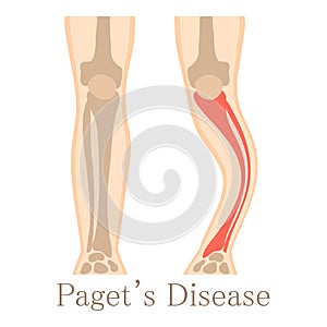 Paget disease icon, cartoon style