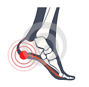 Pain of the heel