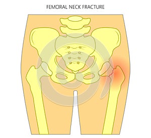 Pain in the hip joint_femoral neck fracture